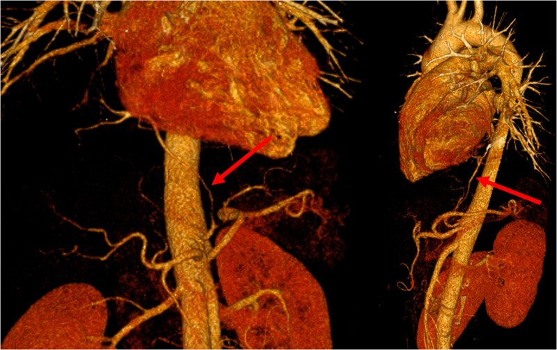 Two unusual variants of pulmonary intra-lobar sequestration.