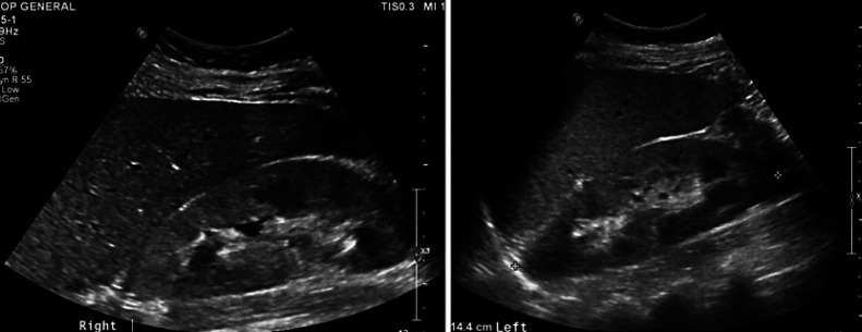 Acute Kidney Injury following Exposure to Formaldehyde-Free Hair-Straightening Products.