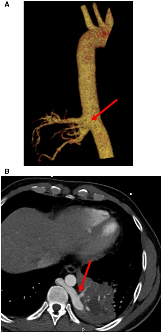 Two unusual variants of pulmonary intra-lobar sequestration.