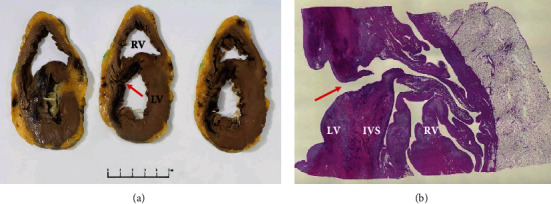 Post-Myocardial Infarction Ventricular Septal Defect Successfully Treated with Impella as Bridge to Cardiac Transplantation.