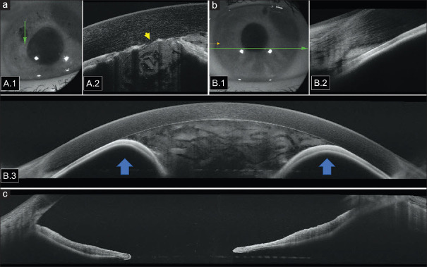 Management of a Bilateral Post-Uveitic Complex Glaucoma with Pupillary Block, Rupture of the Anterior Lens Capsule, and Malignant Glaucoma following Laser Peripheral Iridotomies: Case Report and Literature Review.