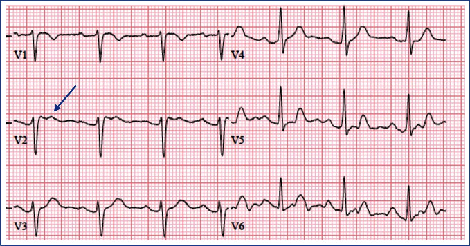 Labor Analgesia in Brugada Syndrome and the Importance of Contingency Planning.