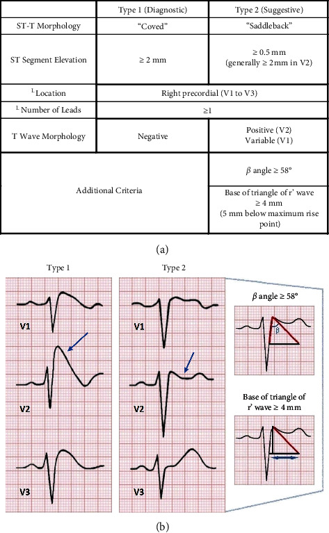 Labor Analgesia in Brugada Syndrome and the Importance of Contingency Planning.