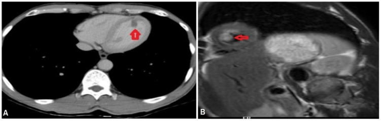 Dabigatran for intracardiac thrombus, yet another promising role of a direct oral anticoagulant: a case report and short review of literature.