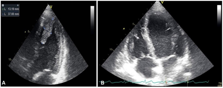 Dabigatran for intracardiac thrombus, yet another promising role of a direct oral anticoagulant: a case report and short review of literature.