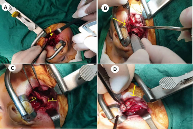 Quantitative and Qualitative Assessment of Medial Osteotomy of the Greater Palatine Foramen in Wide Cleft Palate Repair.