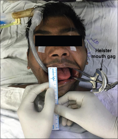 Heister mouth gag aided endotracheal intubation in patients with maxillofacial trauma: A case report.