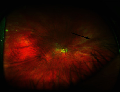 Neovascular Glaucoma from Ocular Ischemic Syndrome Treated with Serial Monthly Intravitreal Bevacizumab and Panretinal Photocoagulation: A Case Report.