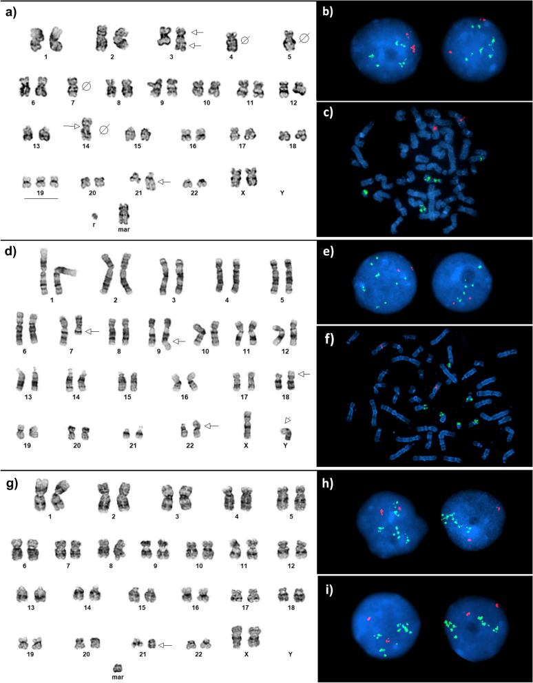 21q22 amplification detection in three patients with acute myeloid leukemia: cytogenomic profiling and literature review.