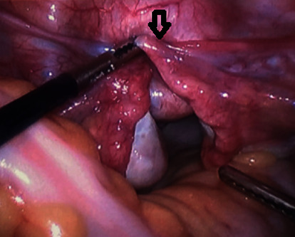 Rhabdomyosarcoma-Induced Uterine Inversion.