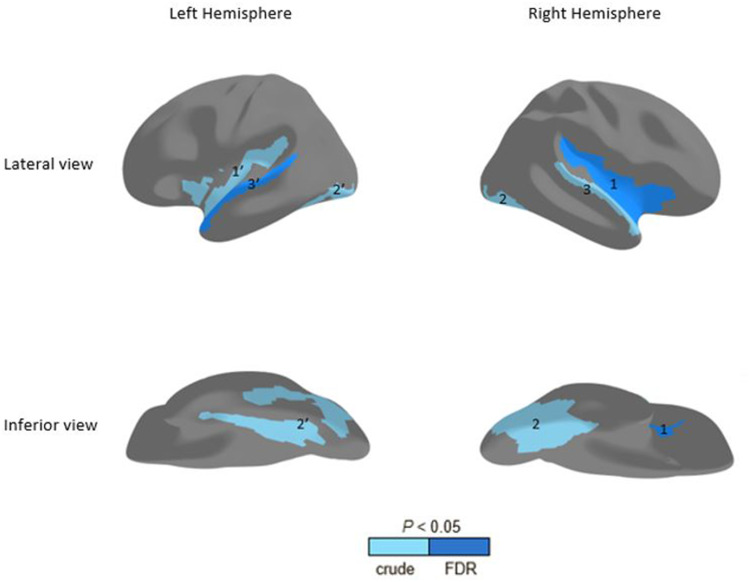 Association Between Vision and Brain Cortical Thickness in a Community-Dwelling Elderly Cohort.