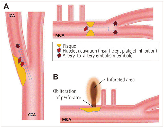 High-on-Aspirin Platelet Reactivity Differs Between Recurrent Ischemic Stroke Associated With Extracranial and Intracranial Atherosclerosis.