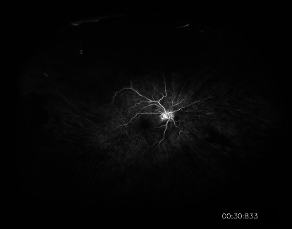 Neovascular Glaucoma from Ocular Ischemic Syndrome Treated with Serial Monthly Intravitreal Bevacizumab and Panretinal Photocoagulation: A Case Report.