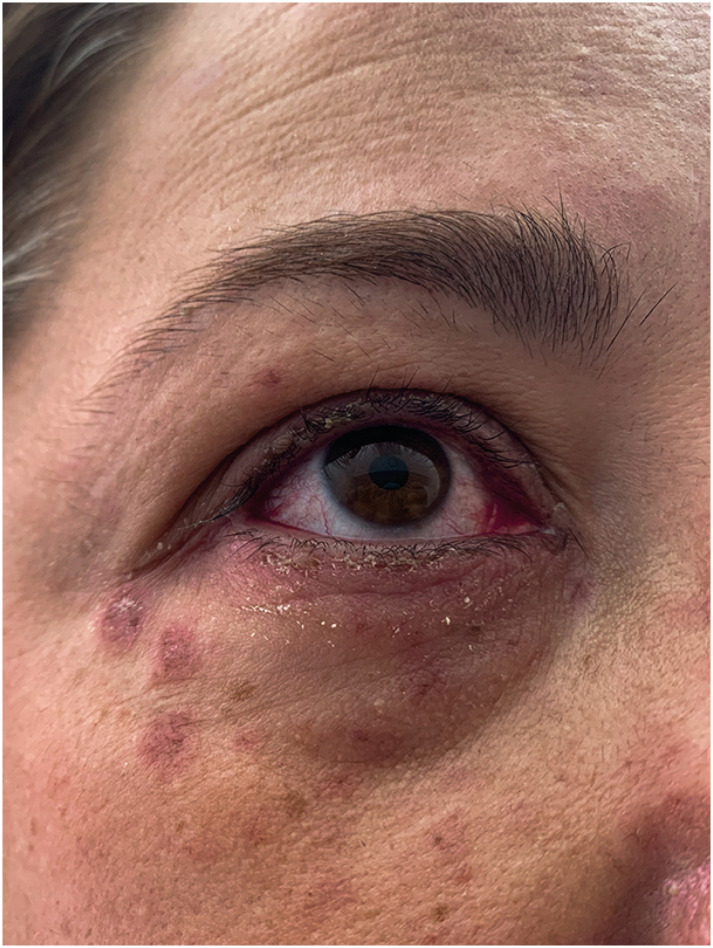 Stevens-Johnson syndrome related with Comirnaty® coronavirus disease 2019 vaccine.