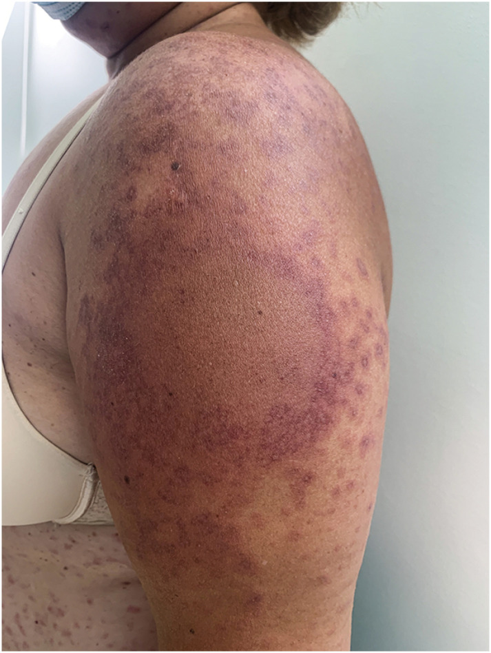 Stevens-Johnson syndrome related with Comirnaty® coronavirus disease 2019 vaccine.