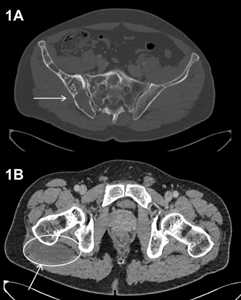 Mazabraud's Syndrome.