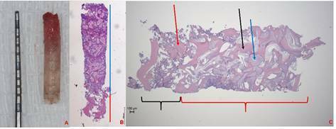 Effect of different thresholds on the accuracy of linear and volumetric analysis of native- and grafted-bone.