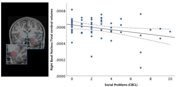 Amygdala subnuclei volumes, functional connectivity, and social-emotional outcomes in children born very preterm.