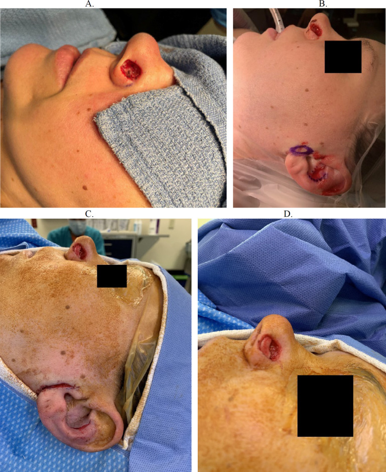 Functional Considerations in Reconstruction of the Nasal Ala.