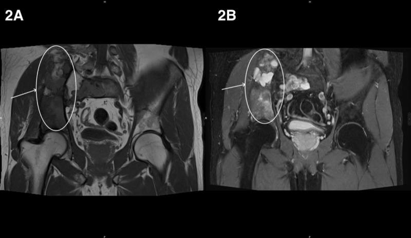 Mazabraud's Syndrome.