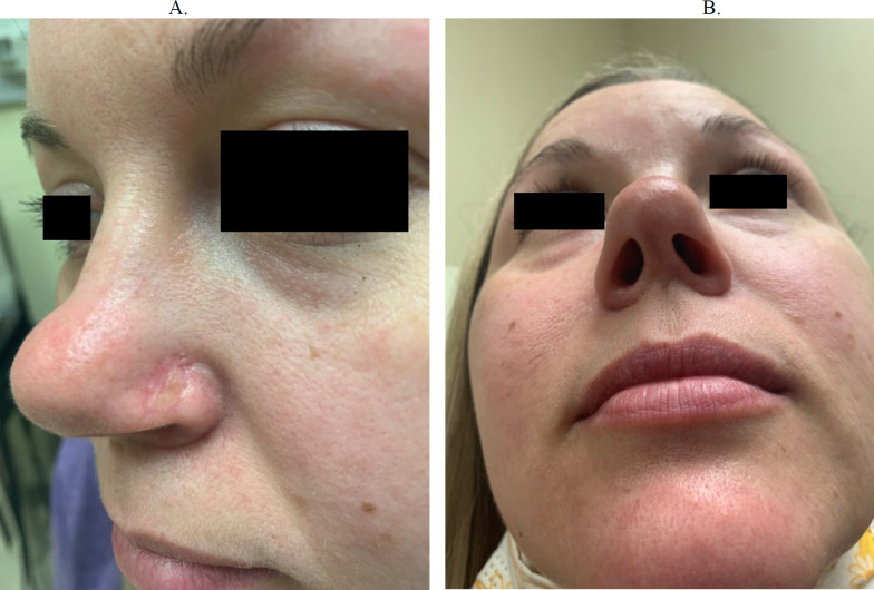 Functional Considerations in Reconstruction of the Nasal Ala.