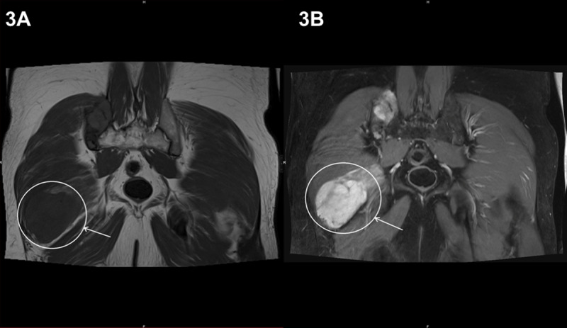 Mazabraud's Syndrome.