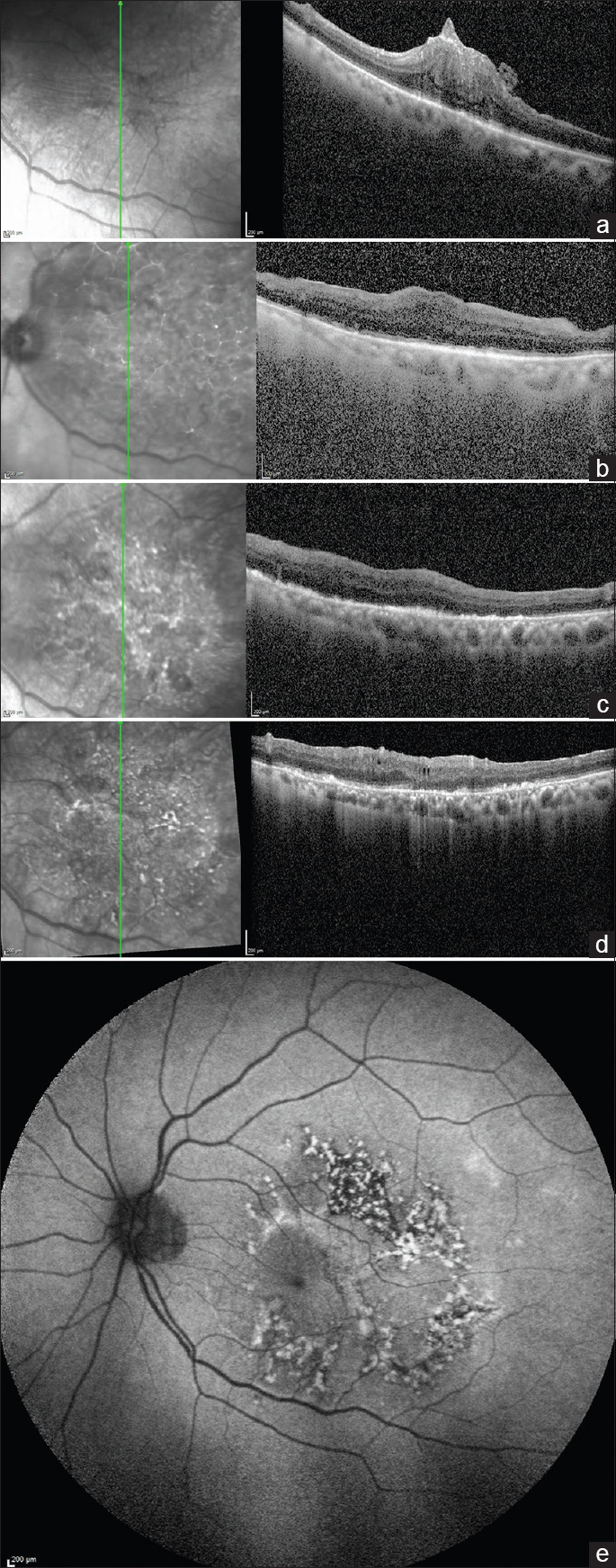 Presumed Combined Brilliant Blue G and Endolight-Induced Macular Damage following Epiretinal Membrane Removal Surgery.