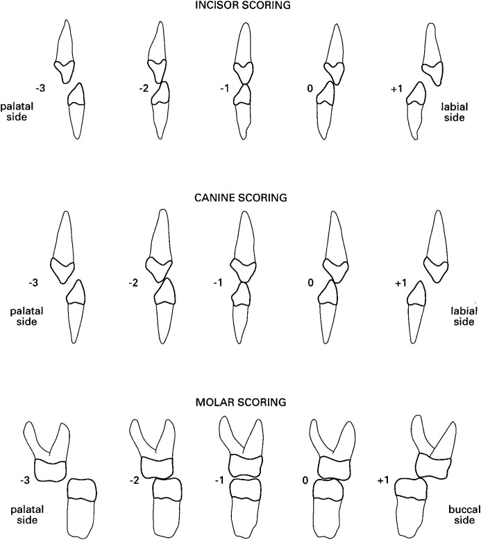 Final Posttreatment Occlusion in Patients With Unilateral Cleft Lip and Palate.