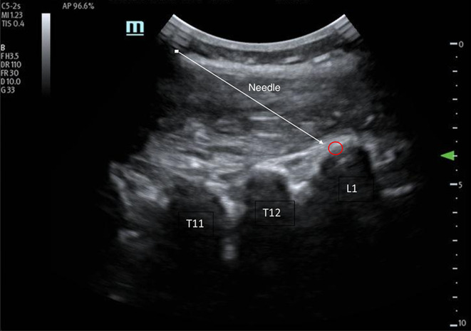 The erector spinae block: a novel approach to pain management in acute appendicitis.