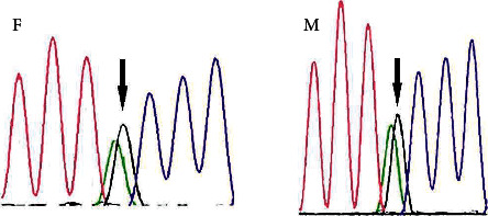 Novel <i>EPG5</i> Mutation Associated with Vici Syndrome Gene.