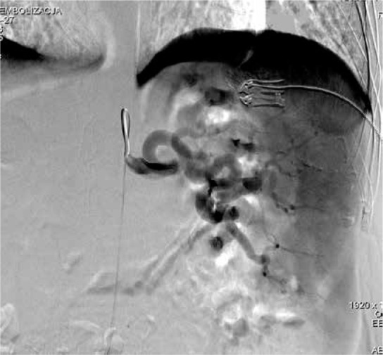 Evaluation of the effectiveness of partial splenic endovascular embolization in patients with refractory thrombocytopaenia.