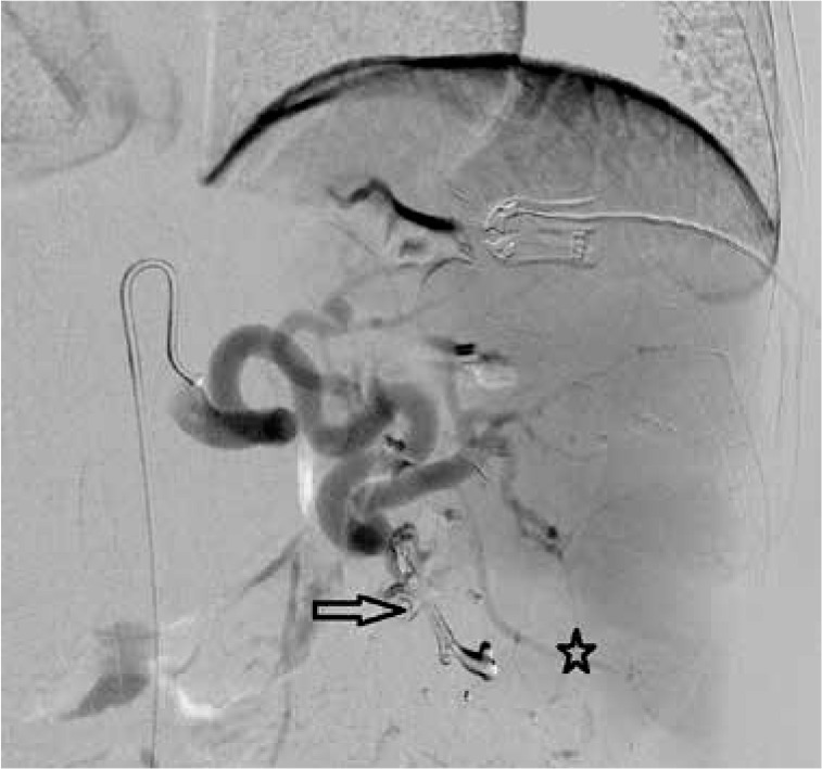 Evaluation of the effectiveness of partial splenic endovascular embolization in patients with refractory thrombocytopaenia.