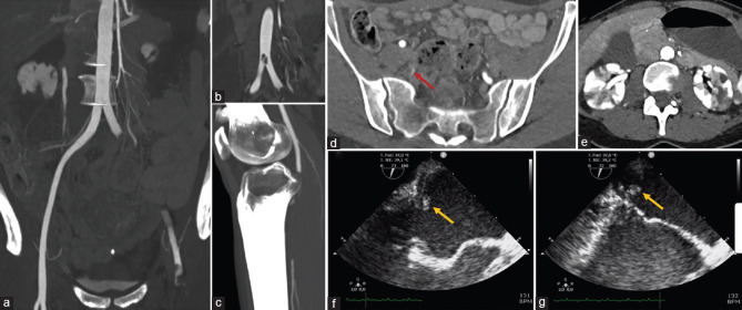 Dramatic Massive Arterial Embolization from a Left Atrial Myxoma in a Patient with Takotsubo Syndrome.