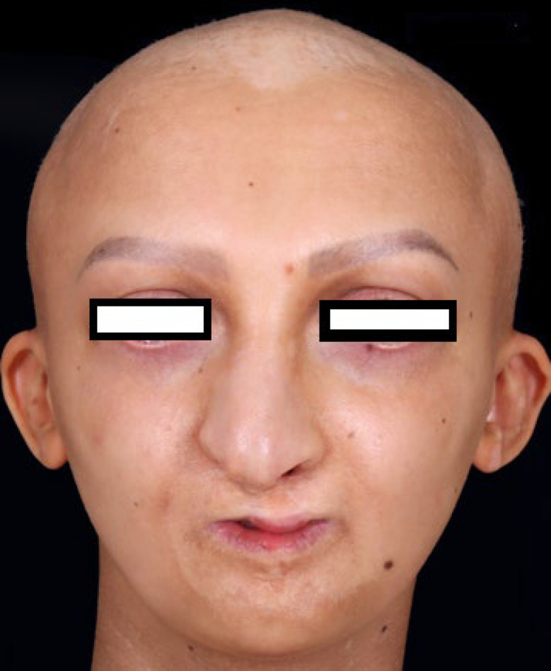 Use of FACIAL ARTERY MUSCULOMUCOSAL and Turbinate Flaps for Rapp Hodgkin Syndrome.