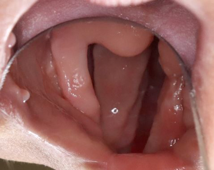 Use of FACIAL ARTERY MUSCULOMUCOSAL and Turbinate Flaps for Rapp Hodgkin Syndrome.