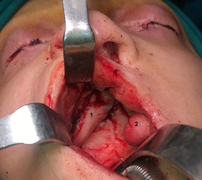 Use of FACIAL ARTERY MUSCULOMUCOSAL and Turbinate Flaps for Rapp Hodgkin Syndrome.