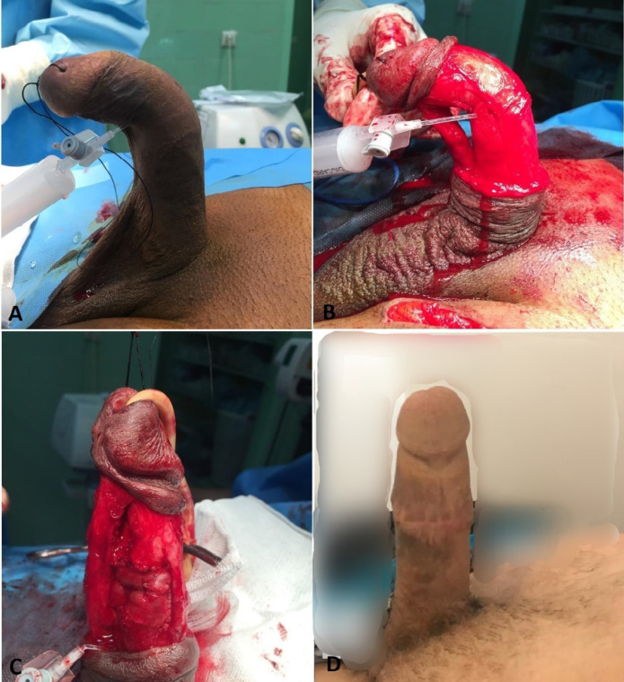 Saphenous Vein Graft for Treatment of Peyronie's Disease, a Comparison between Single and Multiple Graft Reconstruction.