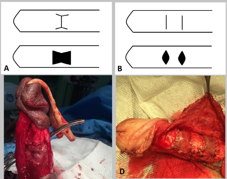 Saphenous Vein Graft for Treatment of Peyronie's Disease, a Comparison between Single and Multiple Graft Reconstruction.