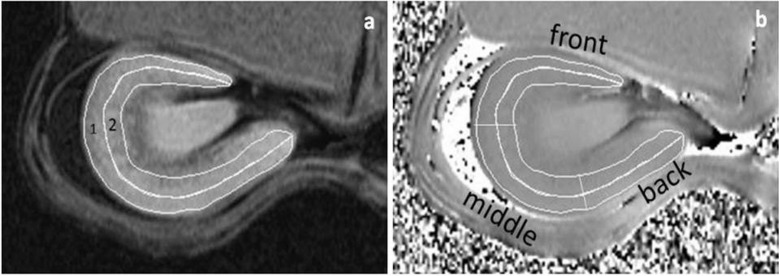 Susceptibility-weighted Imaging for Renal Iron Overload Assessment: A Pilot Study.