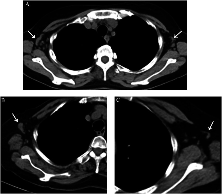 Comparison of the axillary lymph node between rheumatoid arthritis and psoriatic arthritis with computed tomography.