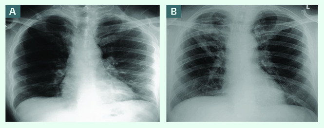 A rare presentation of <i>Mycobacterium africanum</i> after two decades: a case report from Brunei Darussalam.