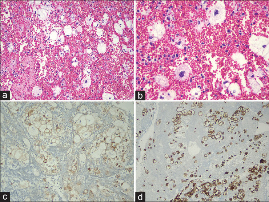 Diagnosis of Lung Adenocarcinoma with Clear Cell Features in Pleural Effusion: Cytomorphologic Features, Immunocytochemical Studies, and Differential Diagnosis.