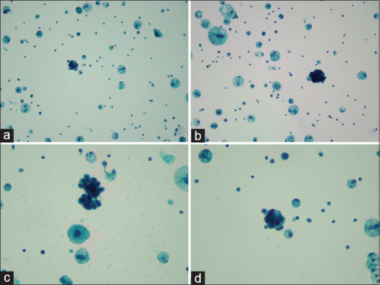 Diagnosis of Lung Adenocarcinoma with Clear Cell Features in Pleural Effusion: Cytomorphologic Features, Immunocytochemical Studies, and Differential Diagnosis.