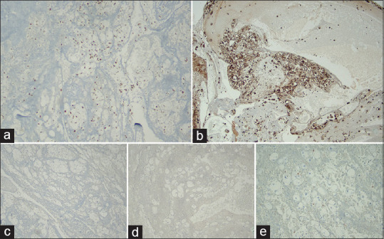 Diagnosis of Lung Adenocarcinoma with Clear Cell Features in Pleural Effusion: Cytomorphologic Features, Immunocytochemical Studies, and Differential Diagnosis.