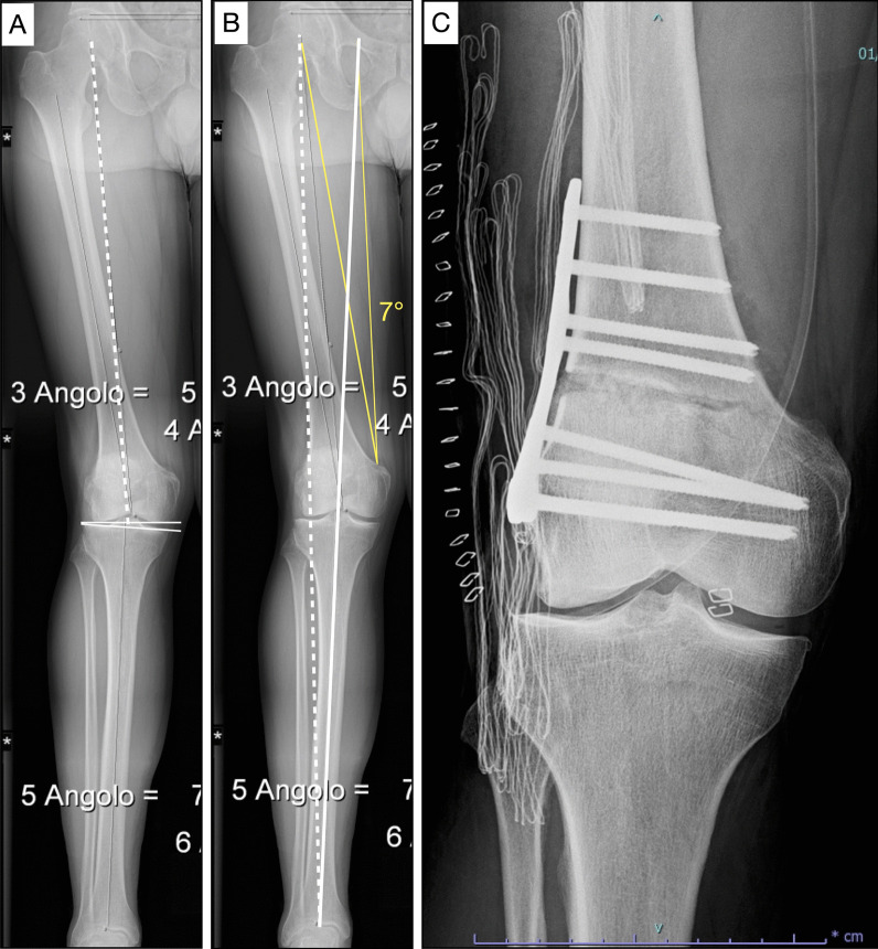 Distal femoral osteotomy versus lateral unicompartmental arthroplasty for isolated lateral tibiofemoral osteoarthritis with intra-articular and extra-articular deformity: a propensity score-matched analysis.