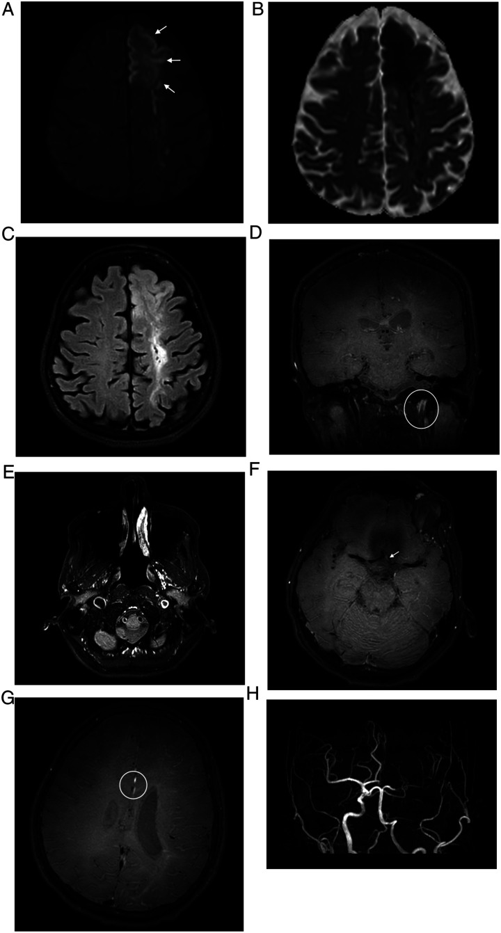 Vessel wall imaging in COVID-19 associated carotid atherothrombosis and stroke: a case report and literature review.