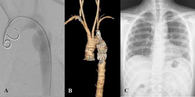 The Role of Surgical and Endovascular Repair of Blunt Traumatic Aortic Injury in the Modern Era: A Single-Center Experience.