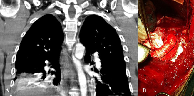 The Role of Surgical and Endovascular Repair of Blunt Traumatic Aortic Injury in the Modern Era: A Single-Center Experience.