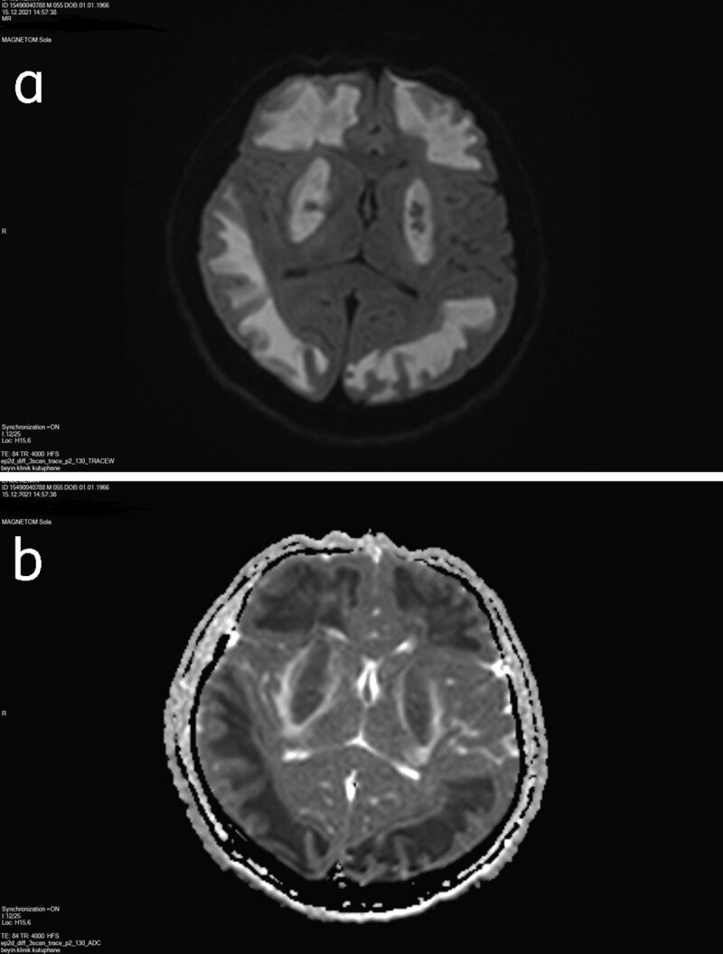 CT and MR Imaging Findings in Methanol Intoxication Manifesting with BI Lateral Severe Basal Ganglia and Cerebral Involvement.