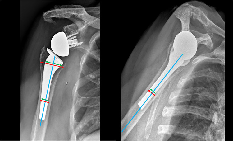 Specific Design of a Press Fit Humeral Stem Provides low Stress Shielding in Reverse Shoulder Arthroplasty at minimum 5 Years FU.